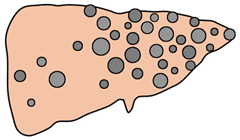 肝嚢胞
