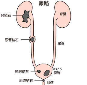 尿路結石